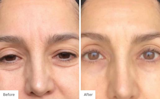 2 - Before and After Real Results photo of a woman's face.